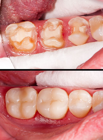 Composite Fillings in Whitehall