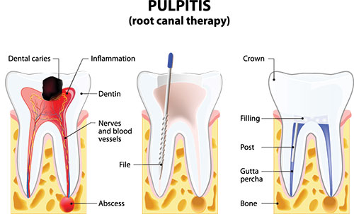 Whitehall Root Canal Therapy