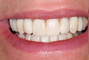 Whitehall Teeth Whitening