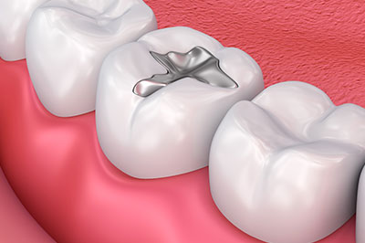 James K Shearer DMD | Night Guards, TMJ Disorders and Dentures