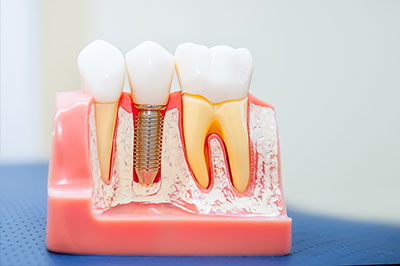 James K Shearer DMD | Implant Dentistry, TMJ Disorders and Ceramic Crowns