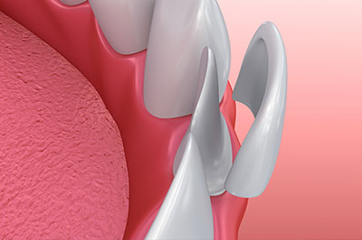 James K Shearer DMD | Veneers, Preventative Program and Oral Cancer Screening