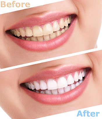 James K Shearer DMD | Preventative Program, Sleep Apnea and Dentures