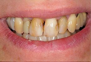 James K Shearer DMD | Teeth Whitening, Veneers and Night Guards